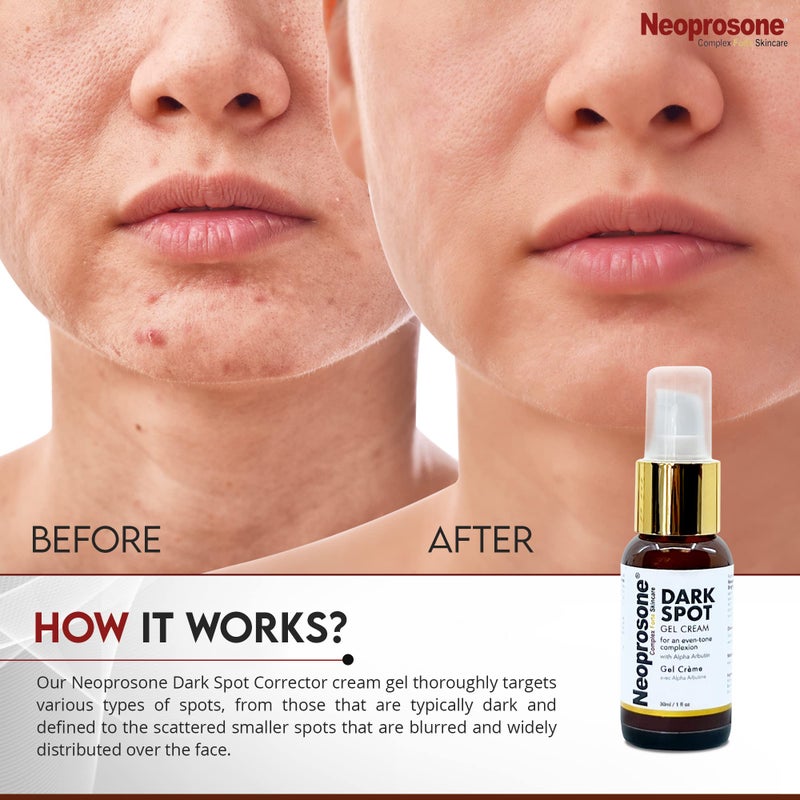 Neoprosone, Dark Spot Remover for Face - 1 Fl oz / 30 ml - Brightening Cream, Reduce Blemishes, Sun Spots, Brown Spots on: Face, Knees, Elbows, Hands, Private Areas - Image 4